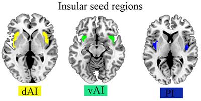 Abnormal Insular Dynamic Functional Connectivity and Its Relation to Social Dysfunctioning in Children With Attention Deficit/Hyperactivity Disorder